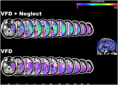 Contralesional Trunk Rotation Dissociates Real vs. Pseudo-Visual Field Defects due to Visual Neglect in Stroke Patients